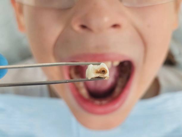 Best Emergency Tooth Extraction in Rupert, ID