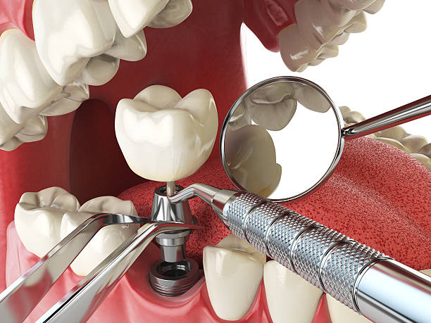 Best Emergency Tooth Extraction in Rupert, ID